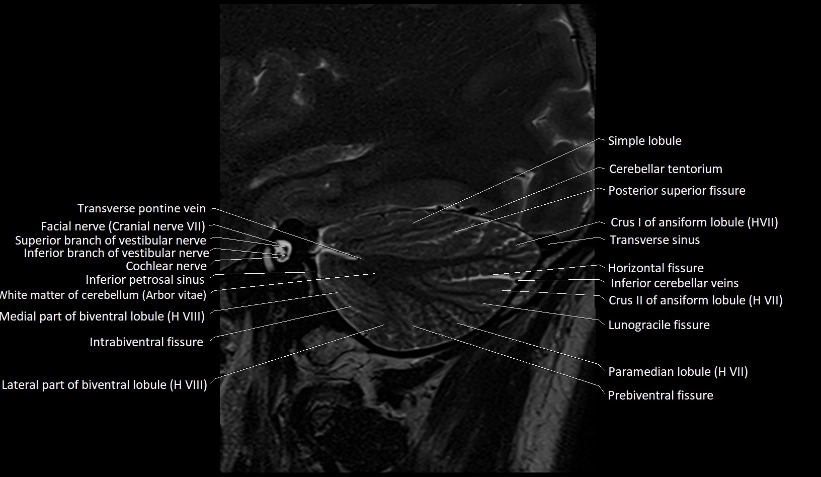 MRI Cerebellar anatomy sagittal High-resolution labelled image 13.webp